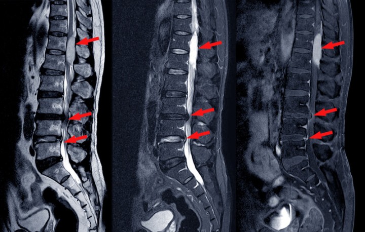 SPINAL STENOSIS & DISABILITY - Cannon Disability Law