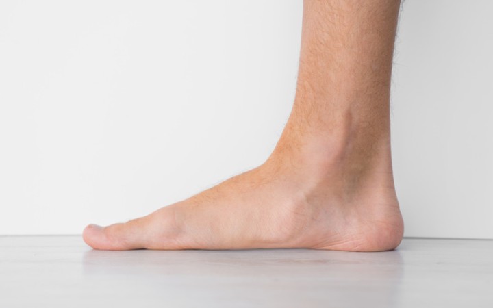 The Essentials Facts About a VA Rating for Flat Feet